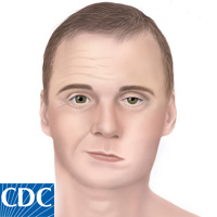 Bells_Palsy_CDC - paralisia facial - imagem em domínio público